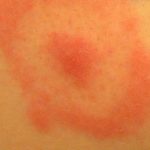 Borreliose-red-ring